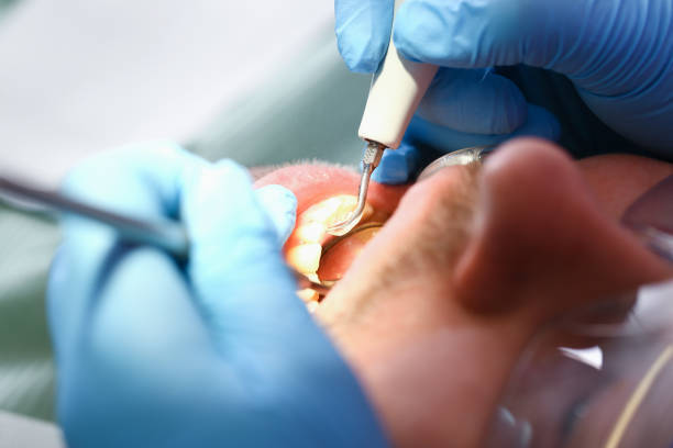 Best Emergency Root Canal Treatment in St Peter, WI