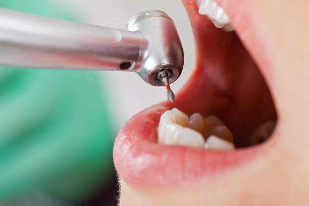 Best Emergency Dental Extractions in St Peter, WI